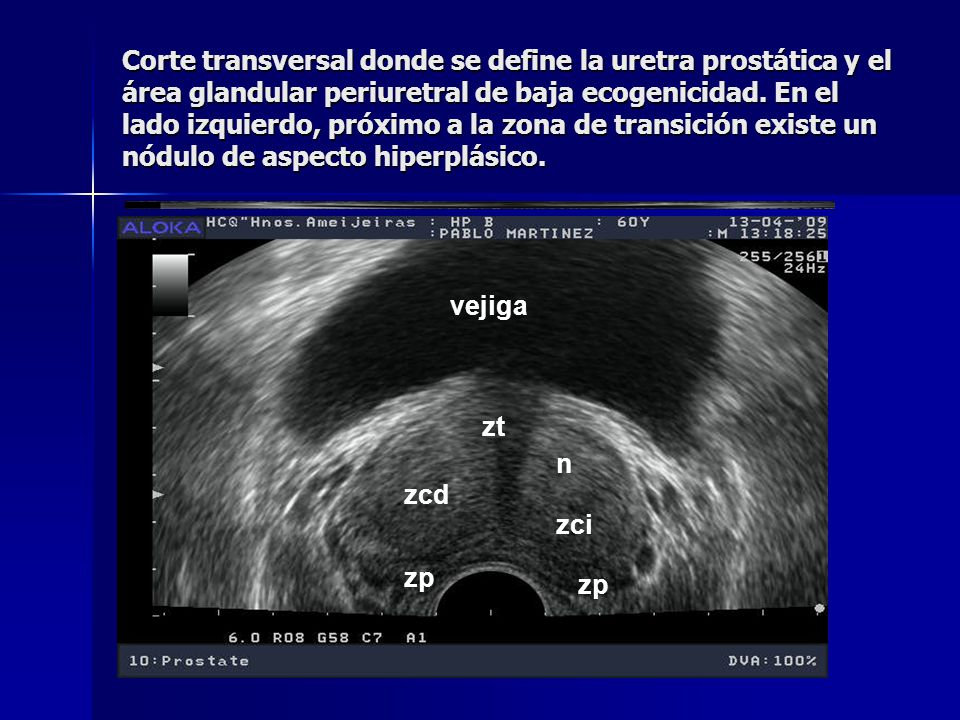 anatomia de prostata ecografia